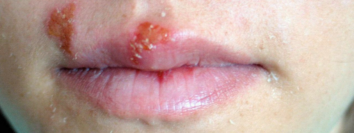 herpes simplex(1)