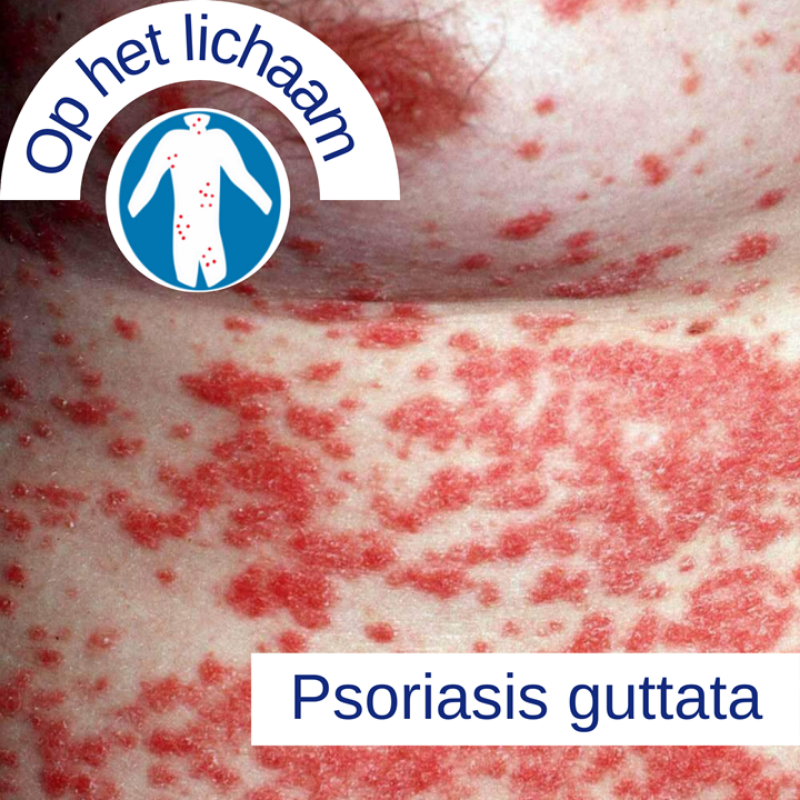 Psoriasis voor OnlDerm (11)