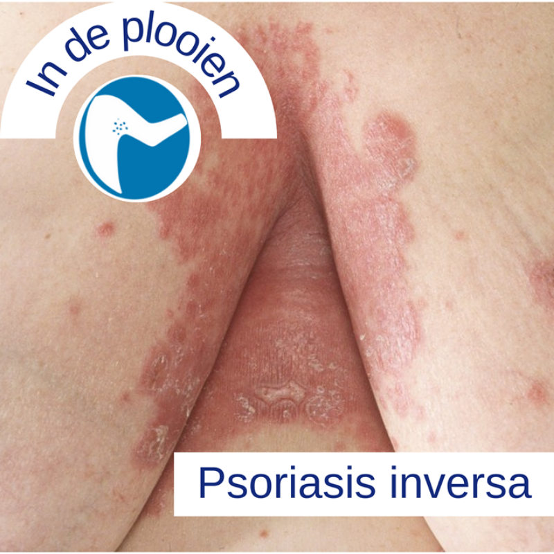 Psoriasis voor OnlDerm (9)